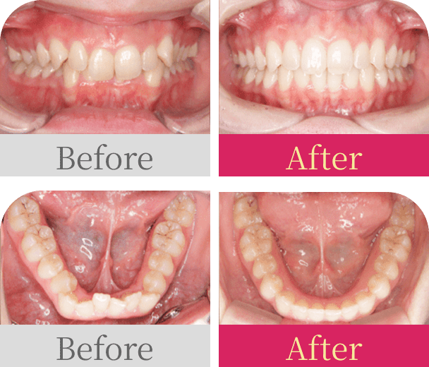過蓋咬合 前歯のガタガタ