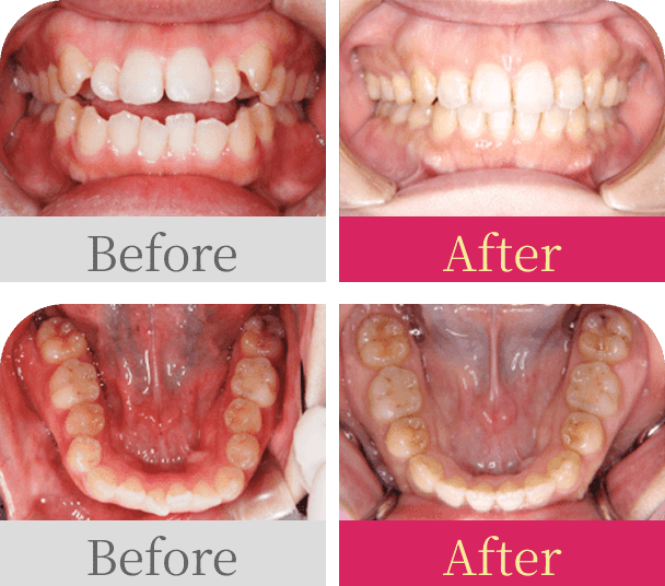 開咬・抜歯 前歯のかみ合わせ