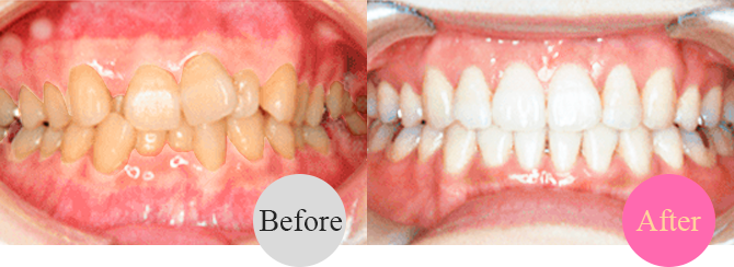 歯の黄ばみ（ホワイトニング併用）